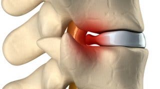 Tratamiento de hernia discal cervical  