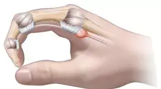 Dedo en gatillo o en resorte. Qué es, causas, síntomas y tratamiento en fisioterapia
