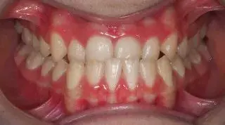 Cómo influye la mordida y la mandíbula en tu postura corporal y tu dolor de espalda