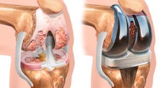 Cirugía de Protesis de Rodilla, Cómo se realiza la operación y cómo es su rehabilitación