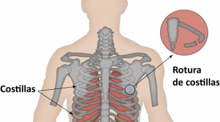 ¿Cómo se pueden disminuir las complicaciones ocasionadas por las fracturas de costillas?