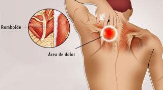 Reeducación postural global en el dolor interescapular