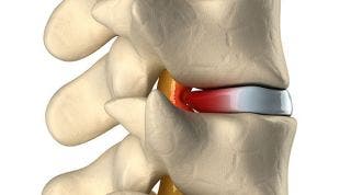 Hernia discal central a nivel L5-S. Causas, síntomas y tratamiento en fisioterapia