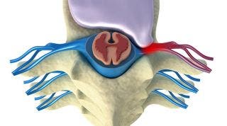 Hernia Discal. Qué es, causas y tipos de lesiones del disco intervertebral
