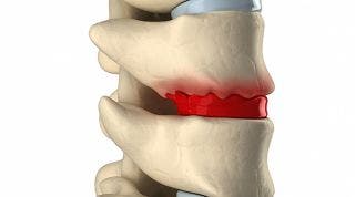 ¿Qué es la Degeneración del Disco Intervertebral?