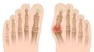 ¿Qué es un Juanete o Hallux Valgus?