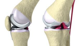 Rehabilitación Prótesis de Rodilla. Ejercicios y consejos prácticos.