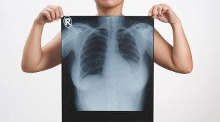 Derrame pleural ¿Qué es? Derrame pleural ¿Qué es?