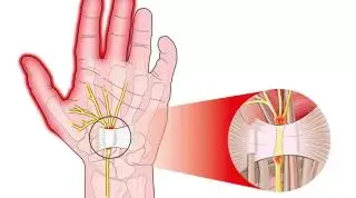 Sindrome del túnel carpiano. Ejercicios y tratamiento recomendado