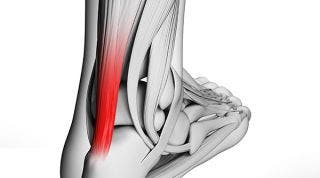 Qué es la tendinitis del tendón de Aquiles y cuales son sus causas síntomas y tratamiento