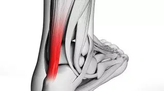 La Tendinitis en el deporte. Tipos, causas, y tratamiento