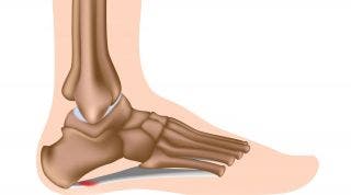 ¿Qué es la fascitis plantar? Causas, diagnóstico y tratamiento