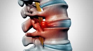 Hernia discal lumbar, ¿tratamiento fisioterápico o tratamiento quirúrgico?