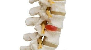 Causas, diagnóstico y tratamiento integrativo para la hernia discal lumbar 