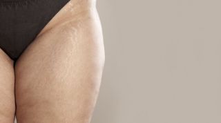 LIPEDEMA: qué es, por qué se produce y tratamiento