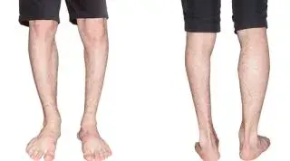 ¿Tienes una pierna más corta? Compensaciones musculares y cómo corregirlas