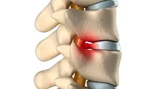 ¿Qué es una hernia discal lumbar? Síntomas, causas y tratamiento