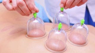 Qué es el Cupping Therapy (Ventosas), para que sirve y como funciona