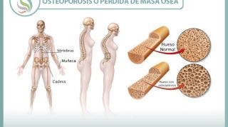 La osteoporosis o pérdida de masa ósea. Un grave problema de los huesos