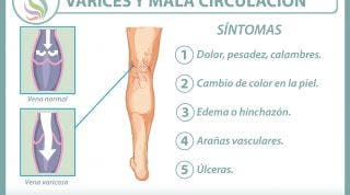 Varices, el castigo de la circulación