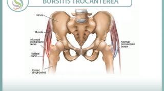 Conoce la bursitis trocantérea o trocanteritis