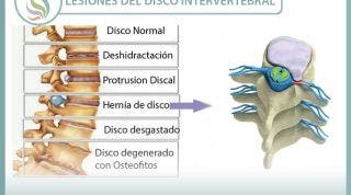 Lesiones más frecuentes del disco intervertebral