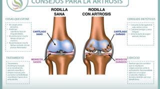 Consejos para tratar la artrosis