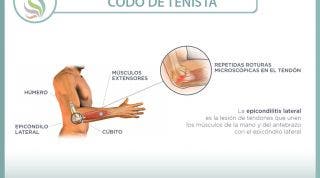 Epicondilitis, epicondilalgia, el martirizante codo de tenista