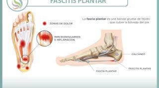 Fascitis plantar. Qué es, cuáles son sus causas y cómo podemos tratarla