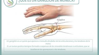 Conoce qué es, por qué se produce y cómo se trata el  ganglión de muñeca o muñeca abierta 