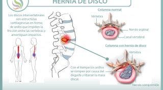 Conoce todo lo que necesitas saber sobre las hernias de disco, causas, consecuencias, síntomas y tratamiento desde la fisioterapia