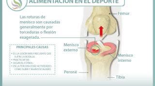 Conoce lo que supone una rotura de menisco, sus causas, consecuencias y tratamiento