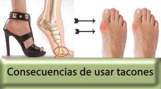 El juanete o hallux valgus, el castigo de la mujer con tacones El juanete o hallux valgus, el castigo de la mujer con tacones