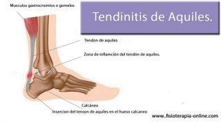 Tendinitis o tendinosis del tendón de Aquiles. Información, consejos y un útil automasaje