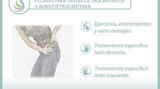 3 claves para tratar la trocanteritis o bursitis trocantérea