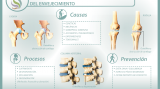 La artrosis, una visión como consecuencia del envejecimiento