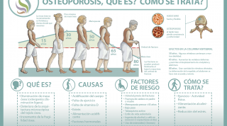Descubre qué es y cómo se trata la osteoporosis u osteopenia