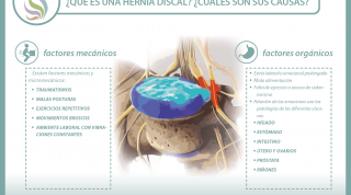 ¿Conoces todo lo necesario acerca de las hernias discales? Te ofrecemos una útil información