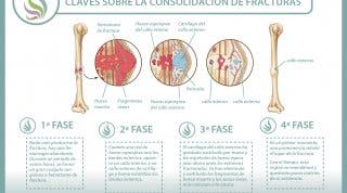 ¿Sabes cómo se consolidan o recuperan las fracturas de huesos? Descubre cómo ocurre