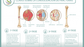 ¿Sabes cómo se consolidan o recuperan las fracturas de huesos? Descubre cómo ocurre