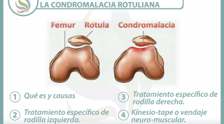 4 claves para entender y tratar la condromalacia rotuliana