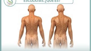 Escoliosis ¿Qué es? Tipos, causas y tratamiento