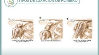 Luxación de hombro. Qué es y cuales son sus tipos