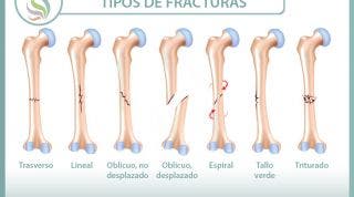 Fracturas óseas, tipos, cuidados y tratamiento