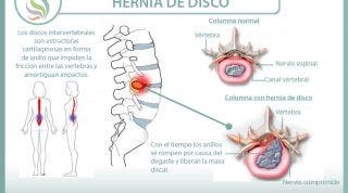 Conoce todo lo que necesitas saber sobre las hernias de disco, causas, consecuencias, síntomas y tratamiento desde la fisioterapia