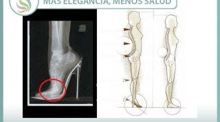 Más elegancia, menos salud. Cuidado con el abuso de los tacones, pueden facilitar problemas de espalda y alterar la correcta postura corporal