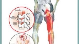 Síndrome piramidal y atrapamiento del nervio ciático, todo lo que necesitas saber