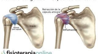 Hombro congelado o capsulitis adhesiva, unos útiles consejos e información para que sepas cómo afrontarlo