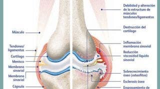 Artrosis, degeneración del cartílago articular, una serie de recomendaciones, reflexiones y consejos sobre el tema