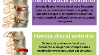 Las hernias discales pueden ser muy diferentes, aprende cómo son algunas de ellas